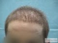 Bad hair surgery outcome: FUE - BHT repair of the worst case