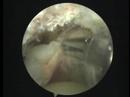 Massive Rotator cuff tear ??????????????
