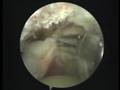 Massive Rotator cuff tear เอ็นหัวไหล่ฉีก