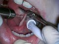 Lingual Frenectomy Lingual Frenectomy