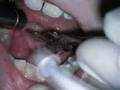 Lingual Frenectomy