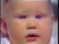 Pendular Nystagmus