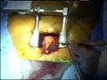 Minimally Invasive Aortic Heart Valve Replacement