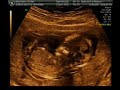 12 Week Ultrasound
