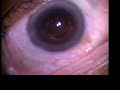 Cataract Eye Operation