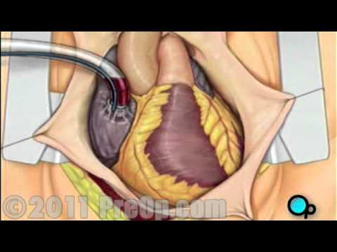 how to repair arteries