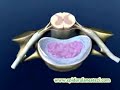 Epidural