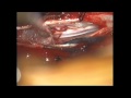 Spinal Tumor (Meningioma) in Thoracic Segment Spinal Tumor (Meningioma) in Thoracic Segment
