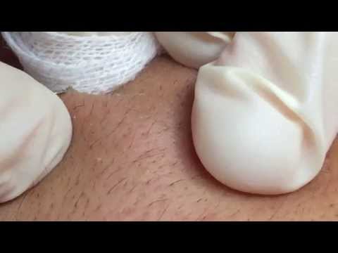 how to avoid whiteheads