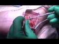 Brostrom-Gould Ankle Reconstruction - Dr. Weatherby