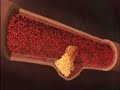 Bio9G Plaque buildup Bio9G Plaque buildup