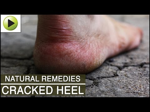 how to get rid cracked heels