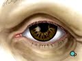 PreOp - Patient Education: Cataract Small Incision Eye pt.2