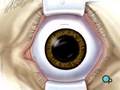 PreOp® Patient Education: Cataract Small Incision Eye pt.2