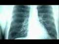 Mystery Diagnosis - Alpha-1 (1 of 2)