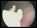 embryoscopy