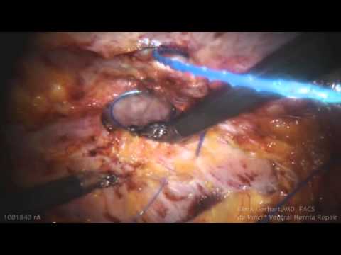 how to repair abdominal fascia