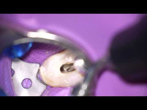 how to treat perforation in rct