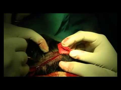 how to transplant your own hair