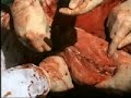 Sutura de Schmieden y Lember de �tero