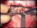 Central neurocytomas resection via posterior transcallosal approach