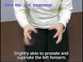 Outcomes of treatment for Parkinson's disease - Example 11  Osteoarthritis Chiropractic