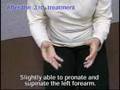 Outcomes of treatment for Parkinson's disease - Example 11