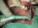 Large Maxillary Molars Implant and Restorations Part 3