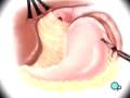 Malpractice Medical Anti-Reflux Laparoscopy Surgery 3