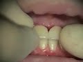 Immediate Implants & Provisionals