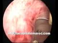 hysteroscopic treatment of intra uterine endometrial polype