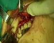 maxillofacial surgery video preview 17