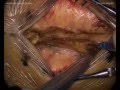 Lumbar interspinous arthrodesis - Posterior approach
