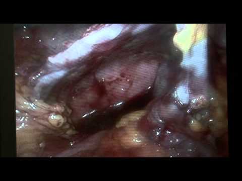 Resseccao de volumoso cisto pelvico por video / Video resection of pelvic cyst