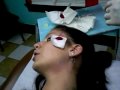 Bloody Facial Dermal Anchor Bloody Facial Dermal Anchor