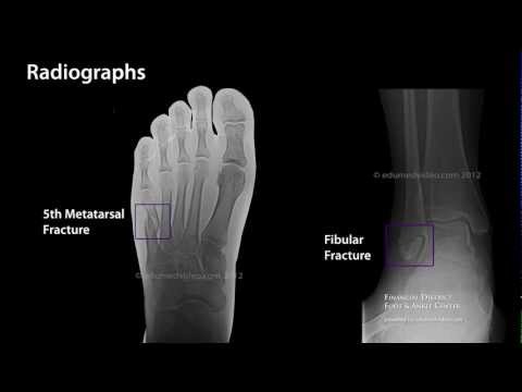 how to cure twisted foot