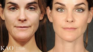 Massai Neck Lift: Katie's Transformation - KAO Plastic Surgery - Before and After