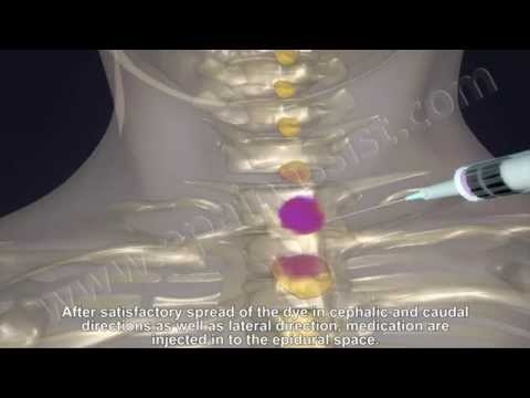 how to relieve epidural pain