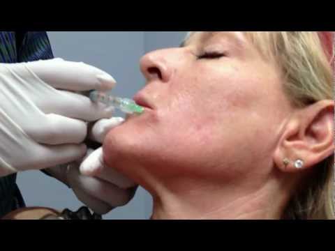 how to dissolve belotero