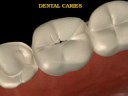 dental caries 3d animations
