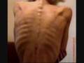 anorexia nervosa