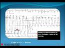 Part 2:pcc_reviewer Valvular Heart Disease (AS/MS)