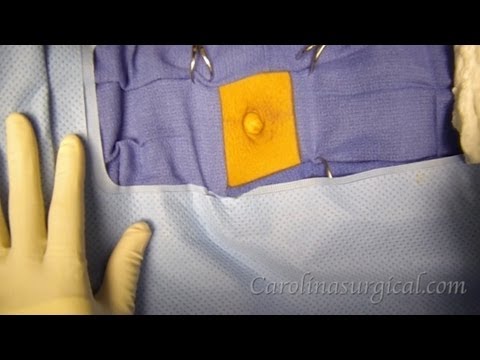 how to repair umbilical hernia