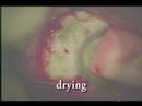 Pterygium resection with amnion graft and fibrin glue Pterygium resection with amnion graft and fibrin glue