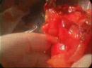 Resección anterior tras colostomia en asa parte ii Colectomy