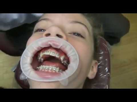 how to fasten braces treatment