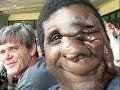 Neurofibromatosis
