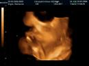 3D Ultrasound of Jacob - 1