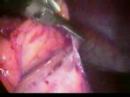 Esplenectomia de Bazo Supernumerario por laparoscopia