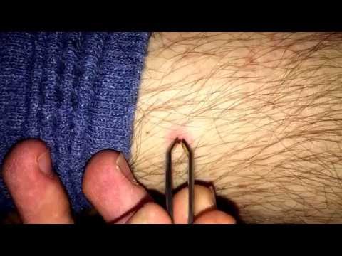 Zecke entfernen Zecken Entfernung mit Zecken Pinzette Anleitung